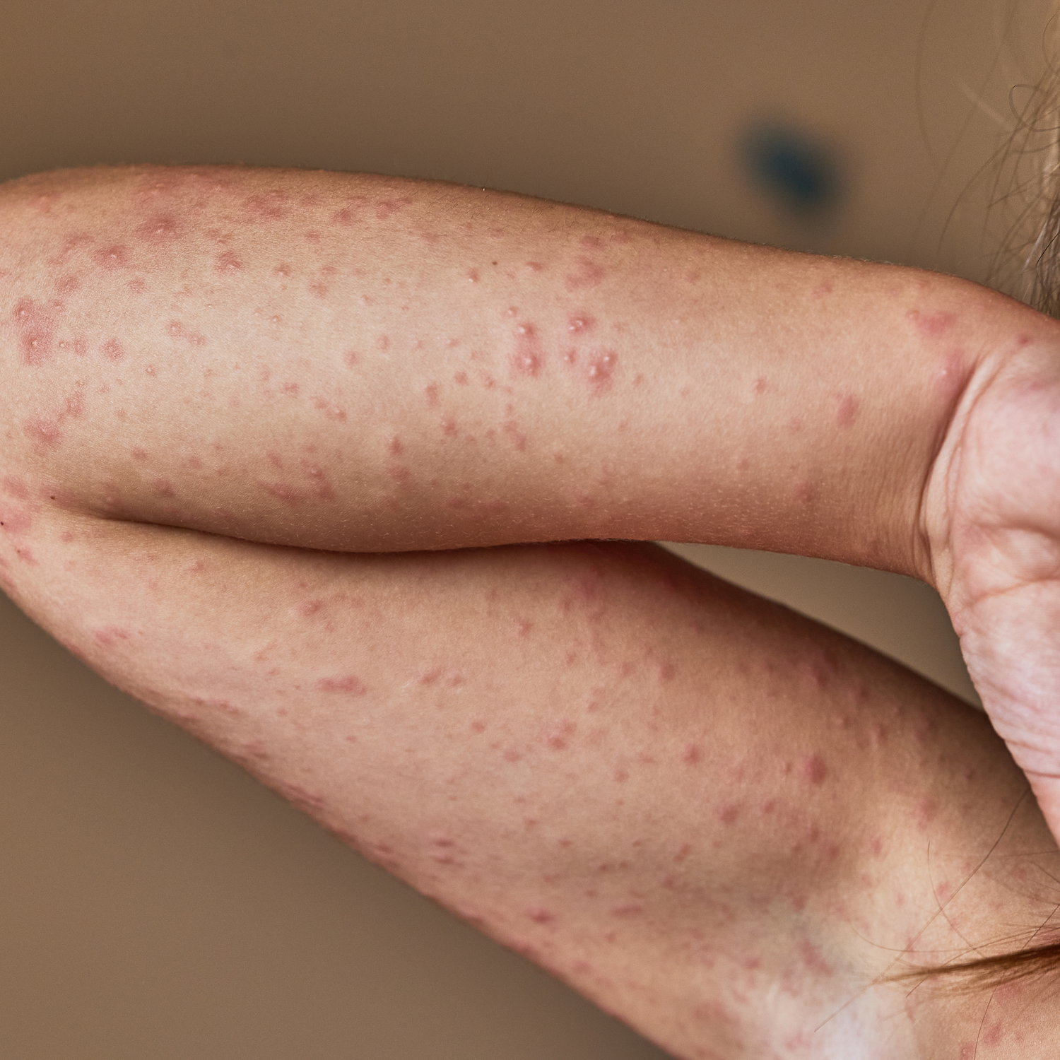 Allergische Reaktion im Gesicht - wenn die Haut Alarm schlägt