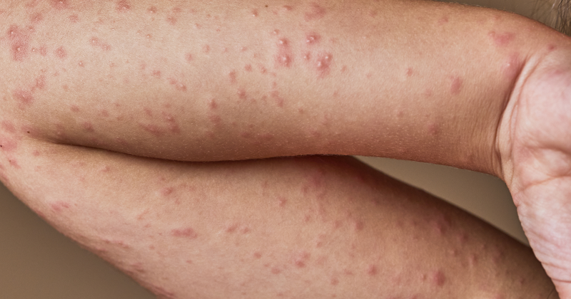 Lemon Rash Understanding Allergic Reaction on the Face & Skin Rash